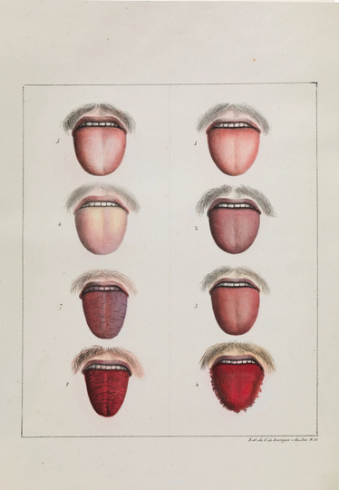 Different Stages Of Yellow Fever By Etienne Pariset & Andre Mazet, 1820 - Postcard